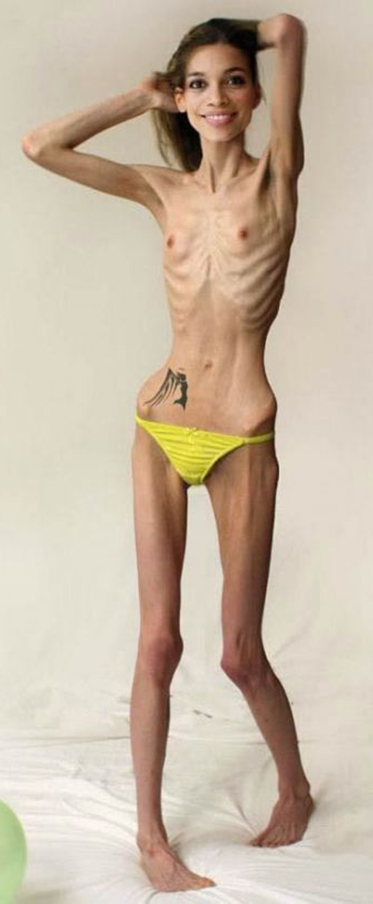 Anorexiás szépség